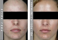 Hiperpigmentacija INNOFACIAL prej/potem
