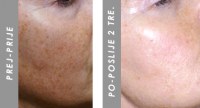 Hiperpigmentacija INNOFACIAL prej/potem